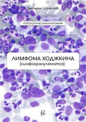 Неврологический дебют неходжкинской лимфомы: сложности диагностики – тема  научной статьи по клинической медицине читайте бесплатно текст  научно-исследовательской работы в электронной библиотеке КиберЛенинка