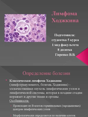 История Венуджи - Лимфома Ходжкина - Lymphoma Australia