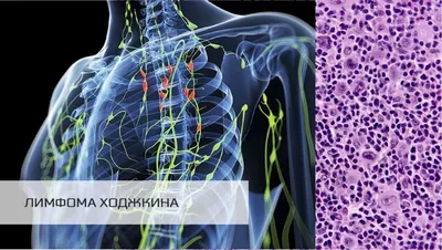 Лимфома Ходжкина проект 2021-2022 | Российский портал онкогематологов