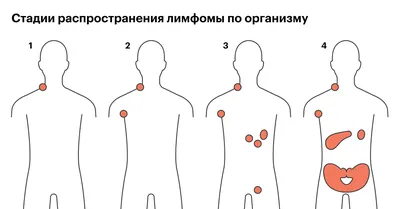 ЛИМФОМА ХОДЖКИНА – тема научной статьи по клинической медицине читайте  бесплатно текст научно-исследовательской работы в электронной библиотеке  КиберЛенинка