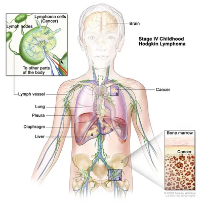 Лимфома: симптомы, причины, типы и стадии заболевания, диагностика и лечение