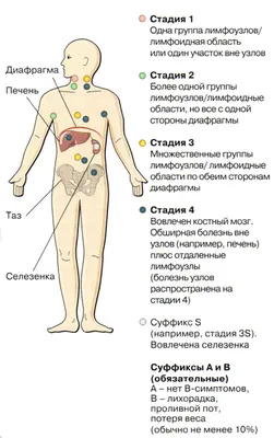 Лимфома Ходжкина: симптомы, признаки, лечение, прогноз