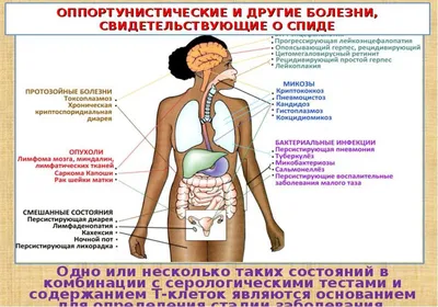 Неходжкинская лимфома (НХЛ): прогноз, симптомы, классификация, стадии,  диагностика и методы лечения лимфом неходжкинского типа