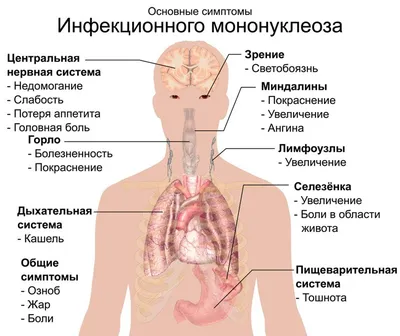 Инфекционный мононуклеоз: причины, симптомы и принципы лечения