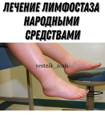 Лечение лимфостаза ноги