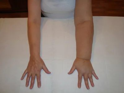 Лимфостаз руки после мастэктомии | Видеоурок по самомассаж | АнгиоЛайф  советы лимфолога