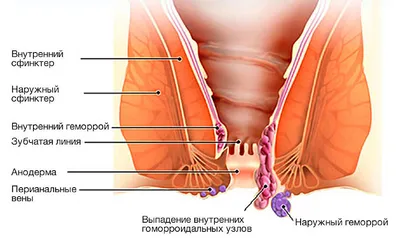 Фиброма - причины появления, симптомы заболевания, диагностика и способы  лечения