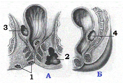 bolezni_rectum.htm