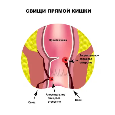 7 важных вопросов об анальной трещине — медицинский центр Формула здоровья