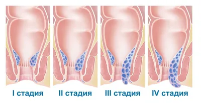 Рак анального канала ~ Диагностика и лечение в Киеве