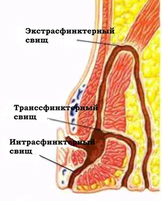 Рак прямой кишки - симптомы, диагностика, лечение