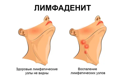 Лимфоузел под мышкой воспалился: что делать и чем лечить у женщин