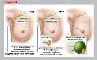 Онко Вики — Стадии рака легкого