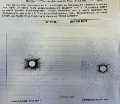 iOncolog - Какая операция нужна при раке молочной железы? Нет, мы не про  сохранение или удаление груди. Подмышечные лимфоузлы – как с ними  поступить? Вырезать все и сразу? Проверять по одному? А