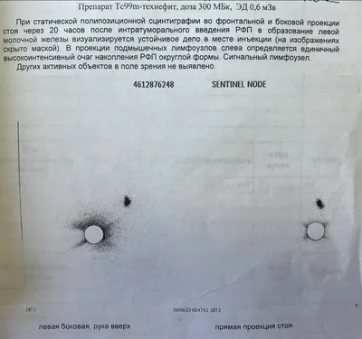 Операции при раке щитовидной железы