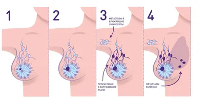 Метастазирование рака молочной железы: особенности и пути метастазирования  при РМЖ