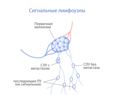 Лимфаденопатия — Википедия