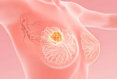 Хирургия лимфатических узлов при раке молочной железы (диссекция) |  Институт груди