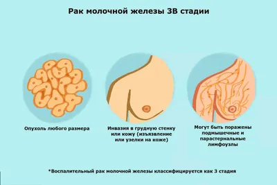 Рак молочной железы: степени и методы лечения - Клиника в Уручье