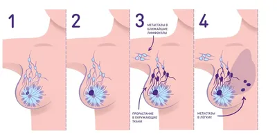 Рак молочной железы - ДЗМ
