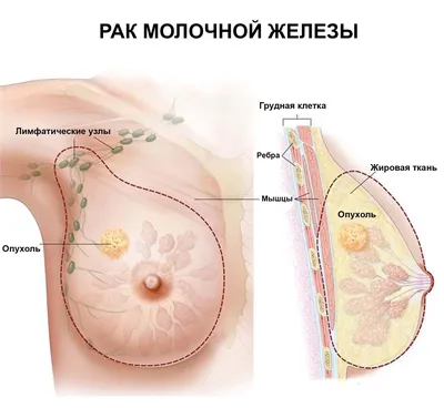 Рак груди 3 стадия, прогноз рака молочной железы 3 степени | Patient-mt.ru