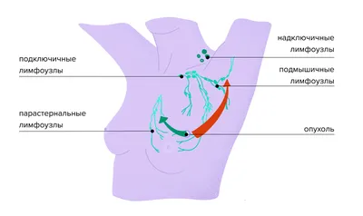 Рак молочной железы:Рак молочной железы: виды, признаки и прогноз после  лечения,Симптомы и первые признаки рака груди,Группа риска | doc.ua