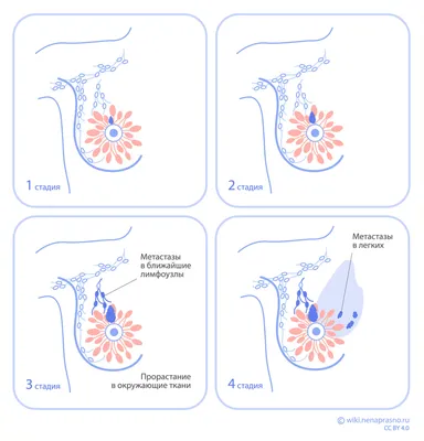 Рак груди операция, органосохраняющая и радикальная операция при раке  молочной железы