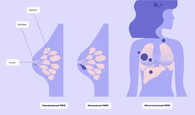 Рак молочной железы: симптомы, признаки, лечение в Москве