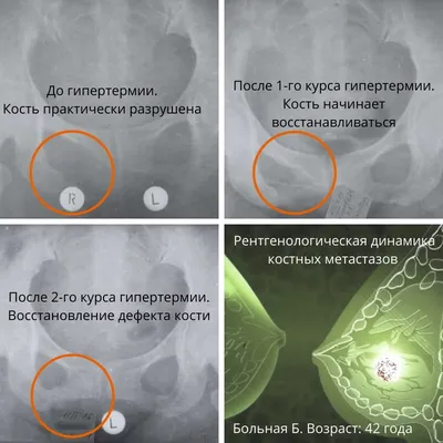 Рак молочной железы:Рак молочной железы: виды, признаки и прогноз после  лечения,Симптомы и первые признаки рака груди,Группа риска | doc.ua