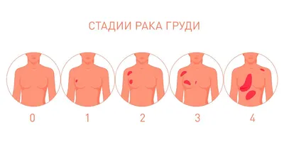 Рак молочной железы II стадии с метастазами в лимфоузлы: IIА и IIВ |  ONCOLOGY.ru | ОНКОЛОГИЯ.ру | Дзен