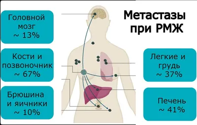 Какие есть стадии рака молочной железы?