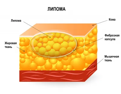 Липома (жировик) - все о заболевании простыми словами