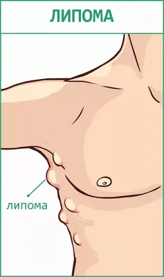 Lipoma накладки для удаления, 12 шт., пластырь для снятия Липомы,  лимфатические узлы | AliExpress