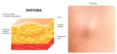 Шар под кожей. Что собой представляет липома и опасна ли она? | Здоровая  жизнь | Здоровье | Аргументы и Факты