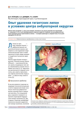 Опыт удаления гигантских липом в условиях центра амбулаторной хирургии –  тема научной статьи по клинической медицине читайте бесплатно текст  научно-исследовательской работы в электронной библиотеке КиберЛенинка