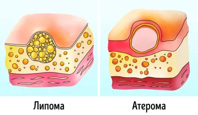 У вас есть жировики (липома или атерома)? Проверьте, надо ли вам её удалять  | Calorizator.ru | Дзен