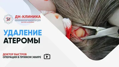 Липома (жировик) - все о заболевании простыми словами