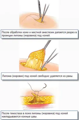 Удаление липомы у ребенка