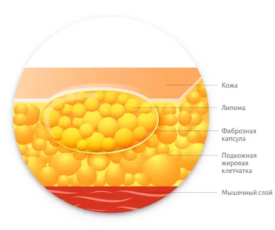 липома | MyPathologyReport.ca