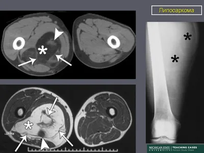 Онкология. Саркома. Липосаркома. + | Портал радиологов