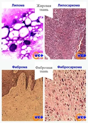 Миксоидная липосаркома | MyPathologyReport.ca