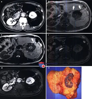 Файл:Edemaliposarcoma.jpg — Википедия