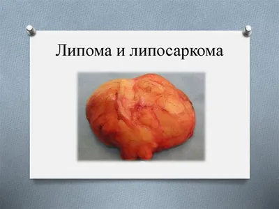 липома - Russian Morphemic Dictionary