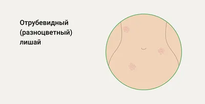 Розовый лишай (Жибера) медицинский плакат А1+, плотная фотобумага от  200г/м2 - купить с доставкой по выгодным ценам в интернет-магазине OZON  (262056336)