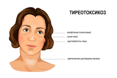 Отеки при гипотиреозе: причины, патогенез, симптомы, лечение отечности