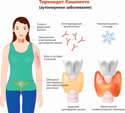 Дифференциальная диагностика неврологического дефицита при гипотиреозе –  тема научной статьи по клинической медицине читайте бесплатно текст  научно-исследовательской работы в электронной библиотеке КиберЛенинка