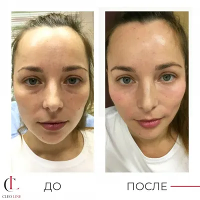 Липофилинг лица собственным жиром в Киеве - Coolaser Clinic