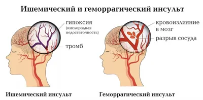 Звезды, которые в молодом возрасте столкнулись с инсультом - 7Дней.ру