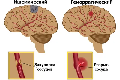 Восстановление после инсульта: советы, рекомендации, особенности - полезные  статьи от специалистов - Медицинский центр «АудиоМед»