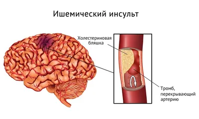 Звезды, перенесшие инсульт - Экспресс газета